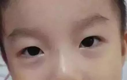                     孩子脾胃怎么样？不看舌苔，眼袋颜色也能告诉你！