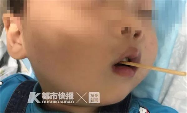                     触目惊心！3岁男孩被竹签从嘴巴直插脑干！这东西很多孩子爱吃！