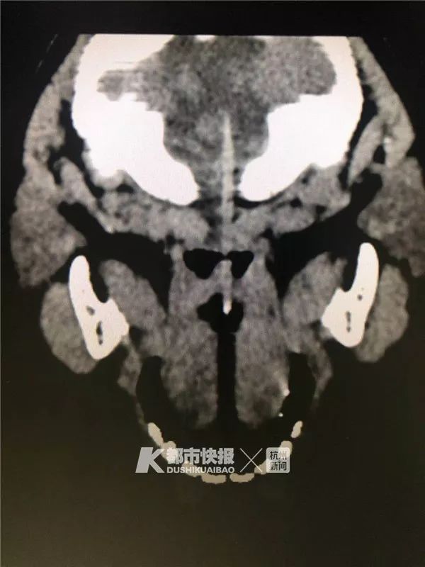                     触目惊心！3岁男孩被竹签从嘴巴直插脑干！这东西很多孩子爱吃！