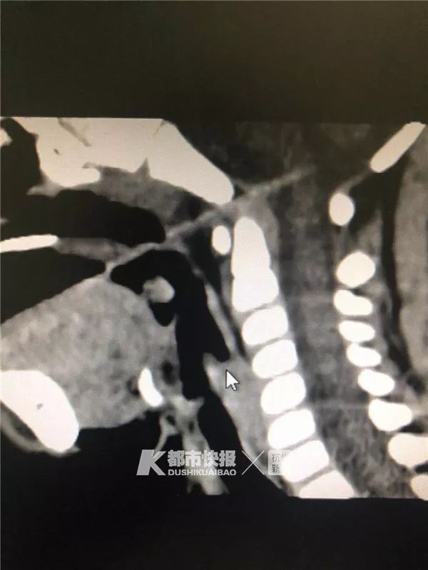                     触目惊心！3岁男孩被竹签从嘴巴直插脑干！这东西很多孩子爱吃！