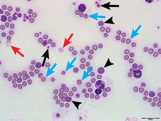 5张经典血涂片全面解读再生性贫血