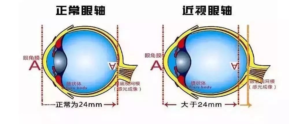 还会导致眼睛变形?真相是.