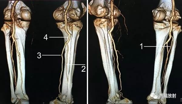 最全下肢血管系统解剖及cta