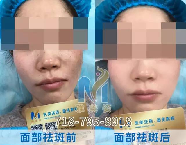 真皮色素斑(颧骨母斑,太田母斑)妊娠纹,痣,肤色均匀净白,,凹坑