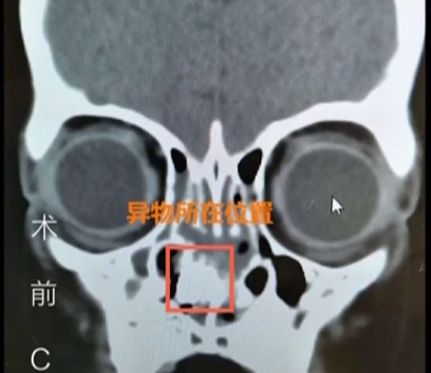                     孩子身上发出阵阵臭味，一看这里全黑了…家长一查发现不对劲
