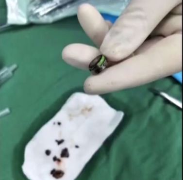                     孩子身上发出阵阵臭味，一看这里全黑了…家长一查发现不对劲