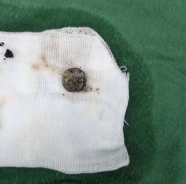                     孩子身上发出阵阵臭味，一看这里全黑了…家长一查发现不对劲