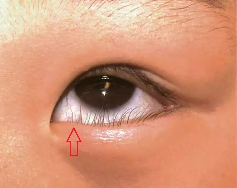                     宝宝眼屎多，家长处理不当险失明！眼屎多竟然也是病？