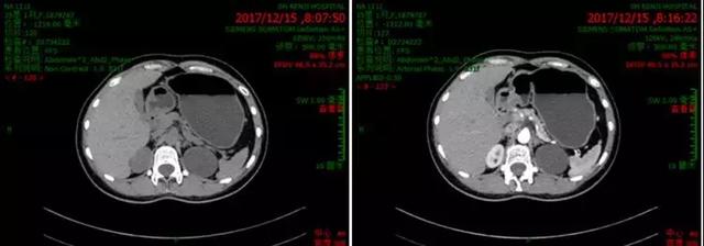 腹部ct平扫 增强(治疗后36月,2017年12月)图13.