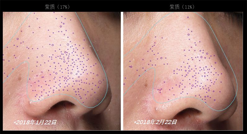 用什么可以去脸上黑头 3332a17c0a6d4e9cb5ffa4e81af24ad3.jpeg