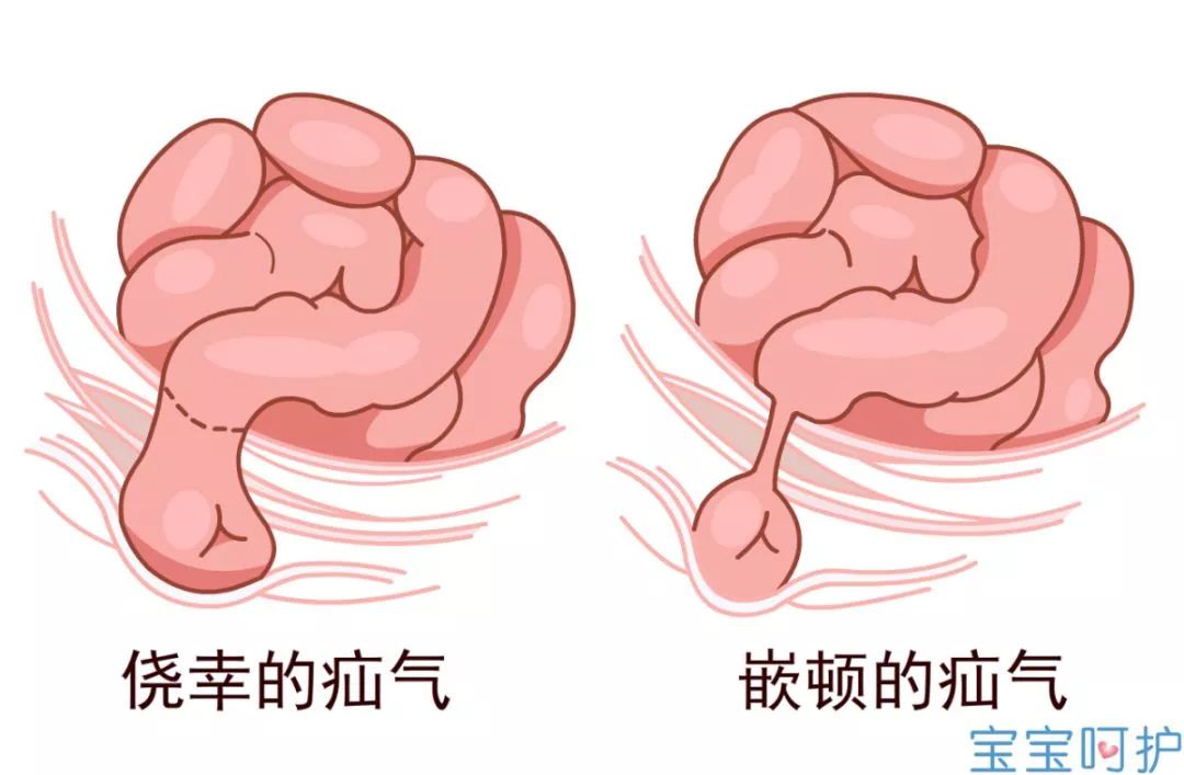                     小儿疝气这样治，可能影响生育能力