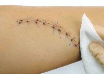 缝针手术留下的疤痕该怎么办