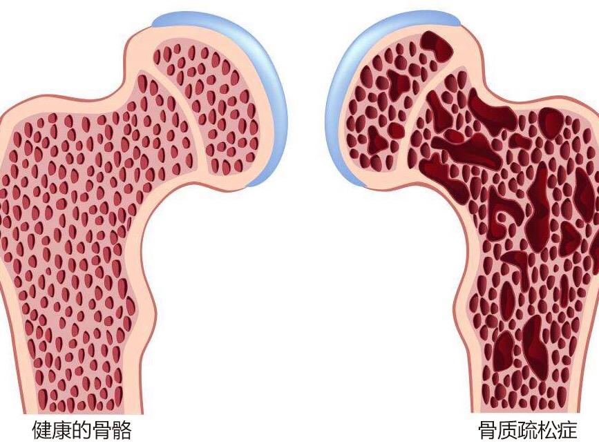 吃什么预防骨质疏松的最佳方法 88b7e0ccacf1425e8cad9e4e90777e69.jpeg