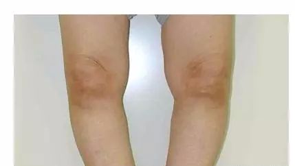 怎么才能缓解大腿疼痛 8af05ae55e0c4a54bee6f6573bdd6223.jpeg