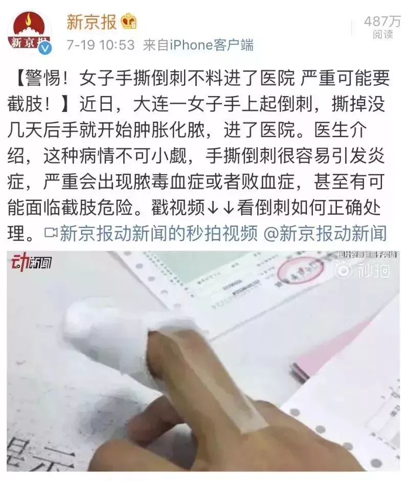                     手撕倒刺可能会出现脓毒症或败血症，甚至可能面临截肢？
