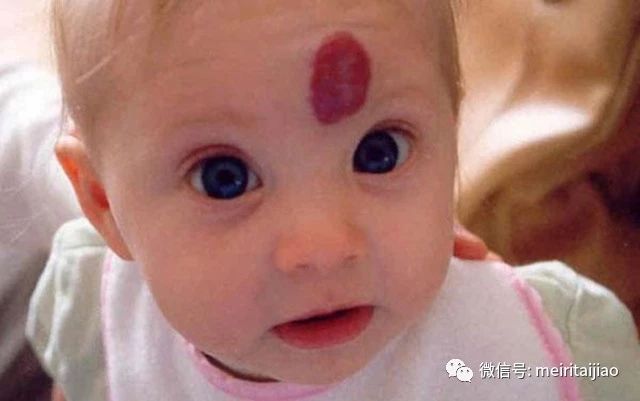                     四维能看到胎记吗？医生的解答出乎意料，如何预防胎儿长胎记？