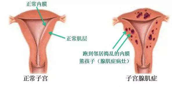 子宫肌瘤子宫腺肌症子宫内膜异位症都有些什么危害