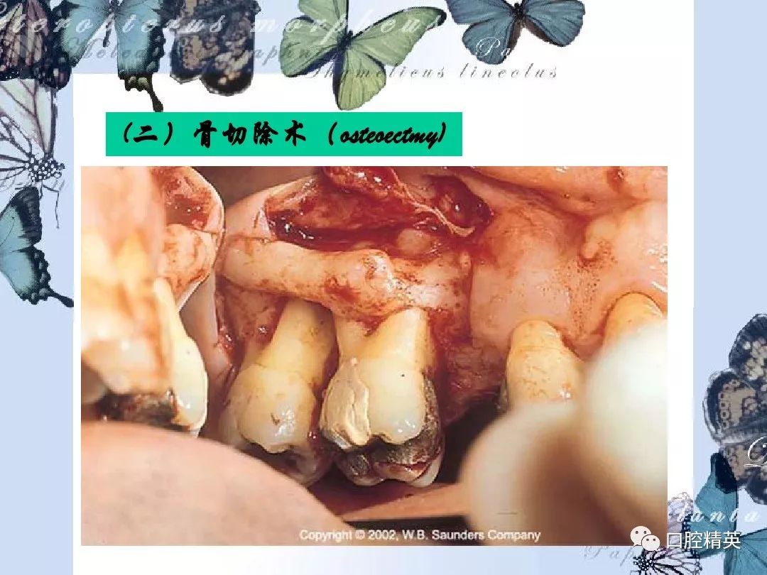 牙槽骨的吸收程度和类型