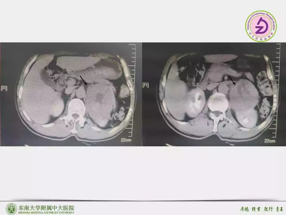 肾上腺皮质癌 (adrenal cortical carcinoma,acc)病例