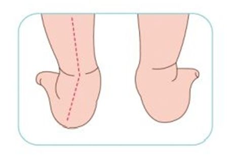 宝宝脚踝外翻之原因一:子宫内压迫 有很大一部分小孩足外翻是天生的