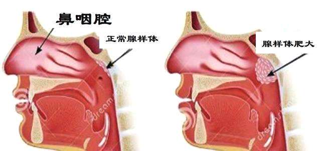 领募:五大饮食习惯,鼻咽癌患者得注意了