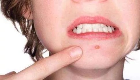 怎么样才能快速长水痘 38ee76819c774b9391b43d762ca56058.jpeg