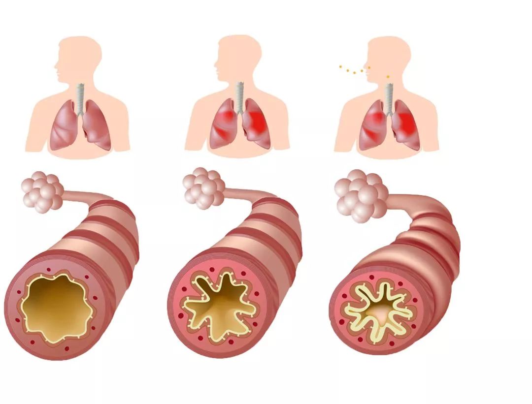 哮喘人口_支气管哮喘图片