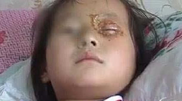                     妈妈给女儿买的生日礼物，差点导致孩子永久性“失明”！