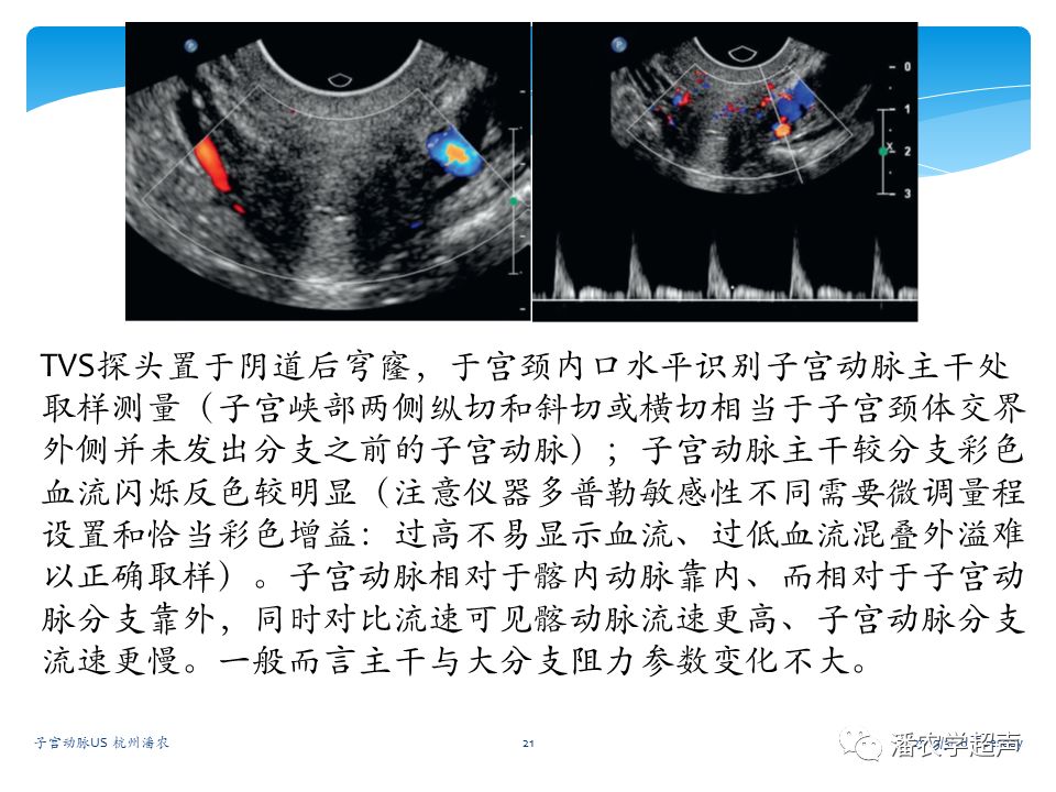 子宫动脉超声检查