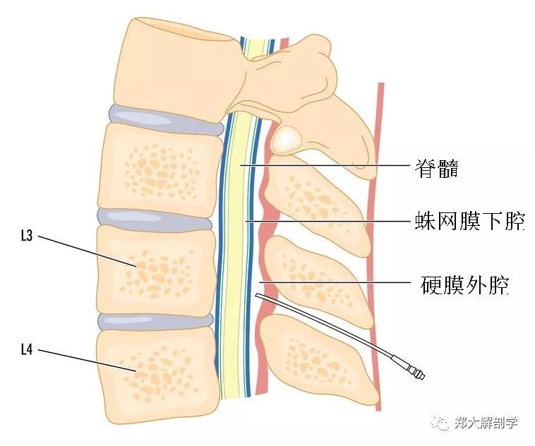 由于脊椎穿刺针或硬膜外导管误置,局部麻醉药可以在硬膜下腔内弥散