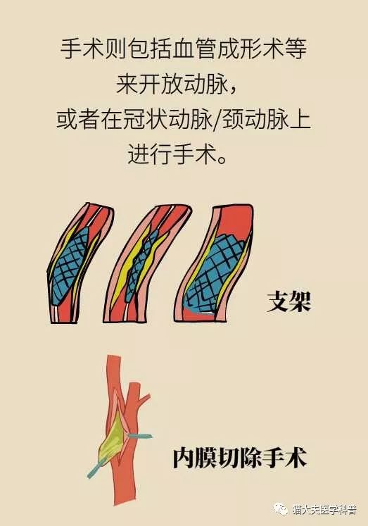 漫画:动脉硬化究竟是怎么回事?能逆转吗?