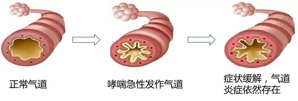 世界哮喘日干细胞技术让你摆脱窒息感