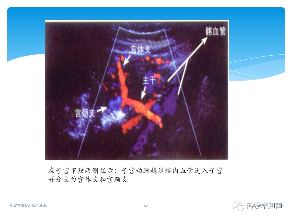 子宫动脉超声检查