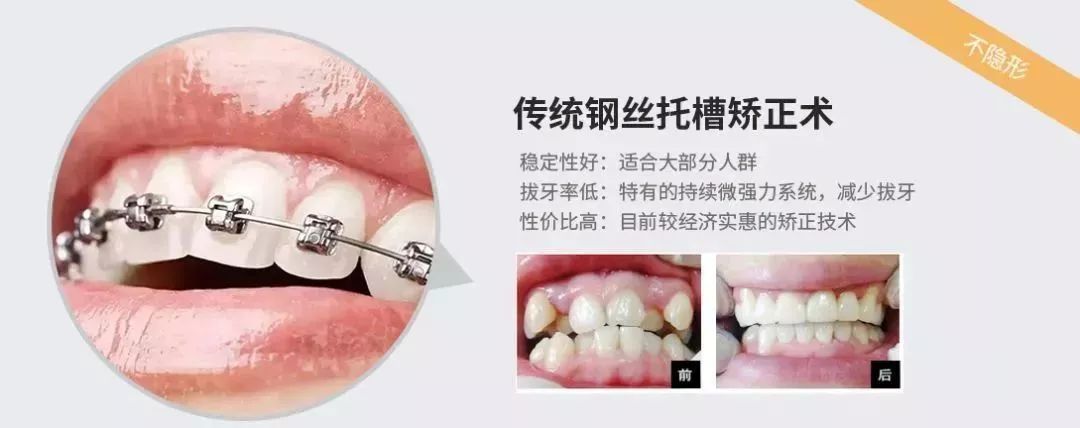牙齿矫正要先拔牙?我犹豫了._再生