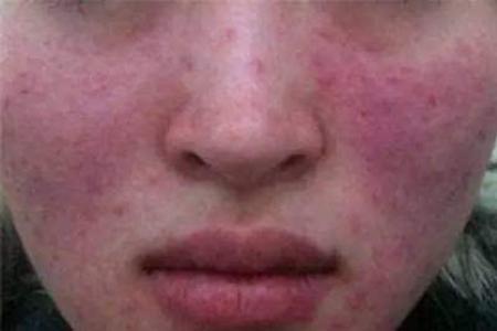 珂语护肤知识 别用这些有 激素 的护肤品 小心被 激素脸 缠上 皮肤