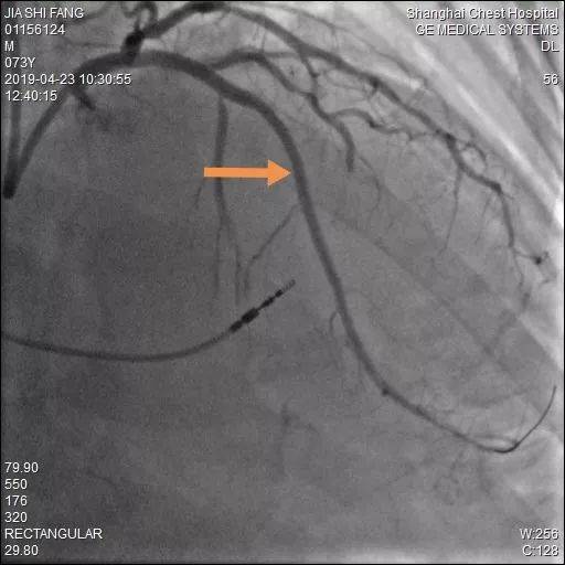 但当心内科冠心病亚专科仇兴标主任看到患者的冠状动脉造影图像时