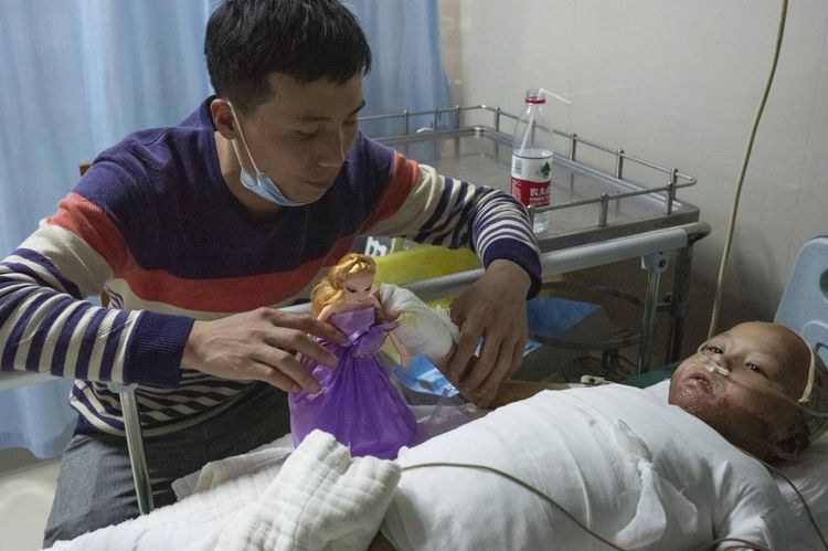                     4岁女童全身严重烧伤，崩溃痛哭：“哥哥为什么要拿火烧我”