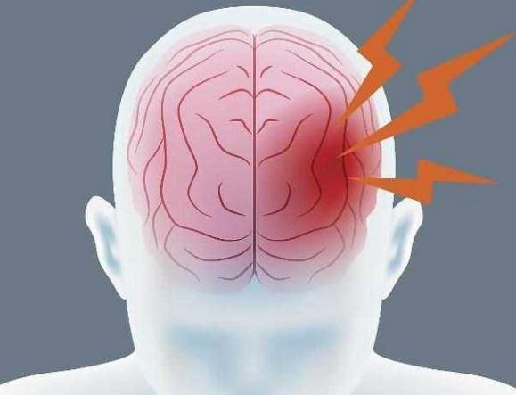 脑出血有哪些原因?