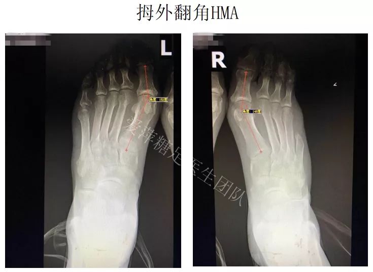 hav>40°;ima>14° 降糖:排除酮症和高渗后,胰岛素强化:餐时加基础