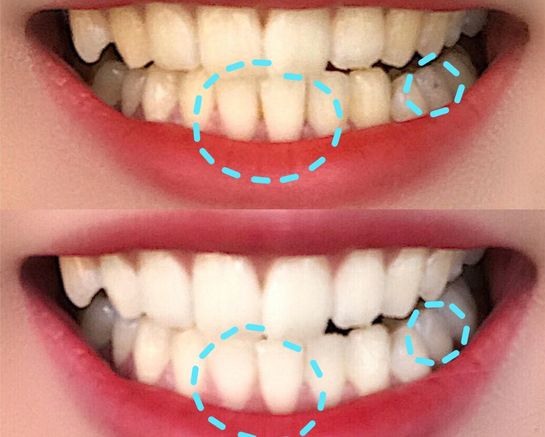 用什么方法可以快速去除牙齿里面的牙结石 c80a34bc82b04e76a39c068a928e77e5.jpeg
