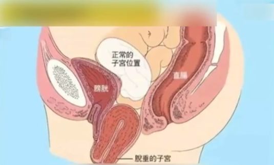 什么手术需要切除子宫 cf9b1f8246a14a7aae8a21608abf7f3c.jpeg
