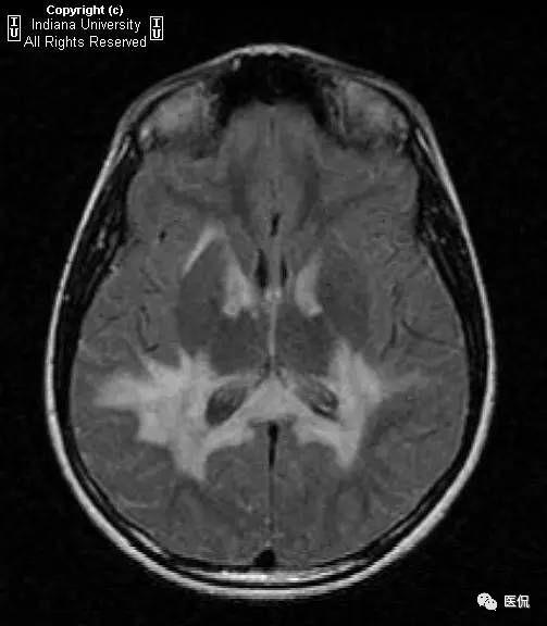 这个遗传病不好诊断看到mri显示对称脑白质信号异常该考虑
