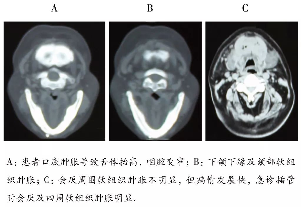 病例解析 | 口腔颌面部间隙感染的麻醉管理