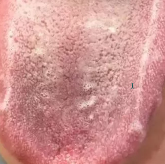 常常表现为头痛或胸痛内热瞀闷,失眠多梦,心悸怔忡,急躁善怒。肝郁舌注意舌头两边的两条白色的细小的唾液