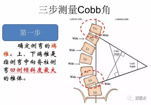 汇总骨科常用角度测量方法全在这里了