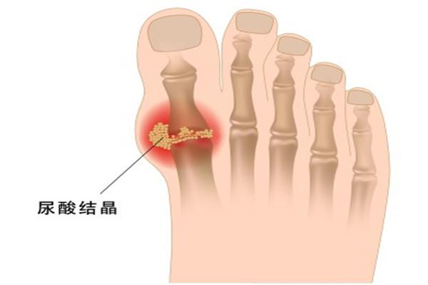 痛风占总人口比例_痛风的症状图片(2)