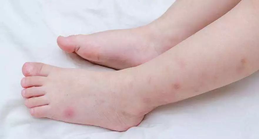 身上发热就痒怎么缓解 2f6d5fbea068481a8a53e902ad7404e0.jpeg