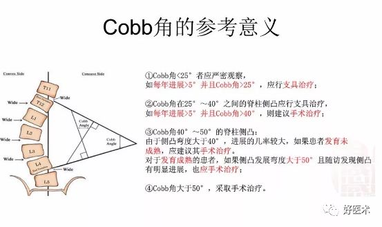 注意:cobb角的测量值每一次不一定了是完全相同,因为:体位,拍片方式