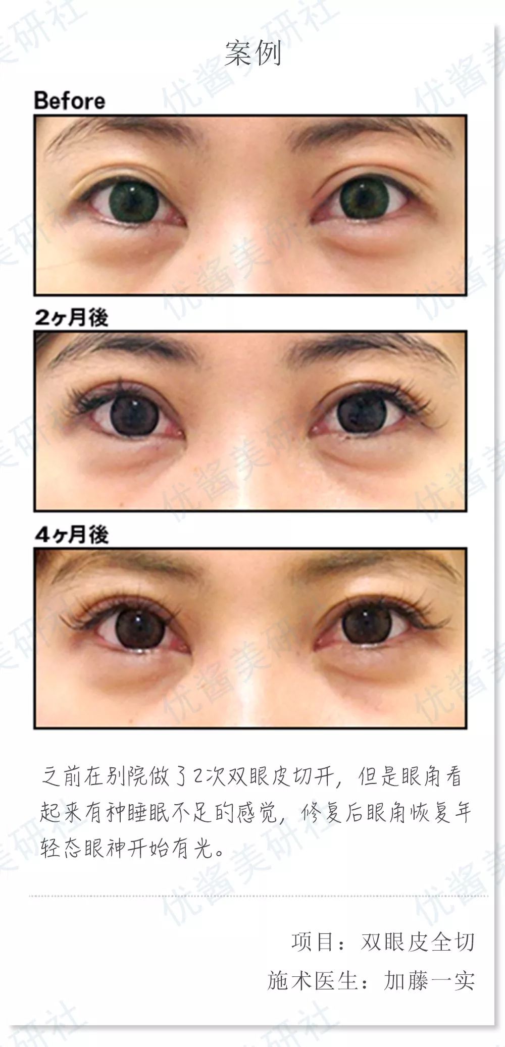 什么是双眼皮肉条感 3bdac3634ded441a9e6197f757eed51a.jpeg