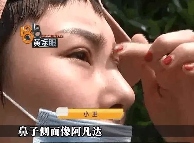 一个长期用玻尿酸的女人,最后竟成了这样! 明升88手机登入网址